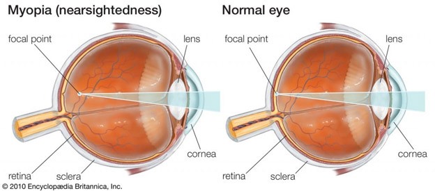 Defining Myopia