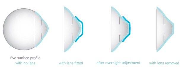 Ortho-K Lenses
